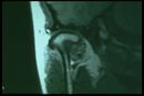 Figure 3: δ1 MNR of the right TMJ in a coronal plane