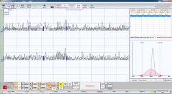 Figure 13b: Lack of the masseterine mechanical Silent Period on both sides which demonstrates the evident lack of motor neuron recruitment from occlusal instability.