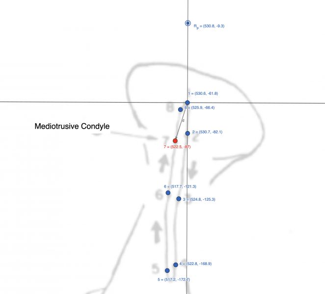 File:Figura condilo mediotrusivo.jpg