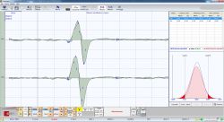 Figure 12a: Determination of the functional component of the Central Nervous System. The results for patient 1 malocclusion show an area of 1.34 mV / ms and 1.46 mV / ms on the right and left masseter respectively. This shows a symmetry difference of 8.2%.