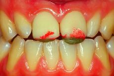 Figure 6b: Frozen Functional Neuro Evoked Centric Registration by placing crown structures in Empress with interdigitating wax. Note the slight increase in the vertical dimension purposely wanted.