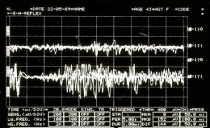 350px-Spasmo emimasticatorio SP.jpg