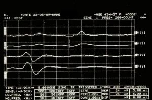 399px-Spasmo emimasticatorio JJ.jpg