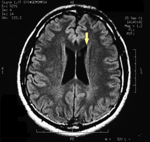 File:Pineal cavernoma post surgery 1.jpeg