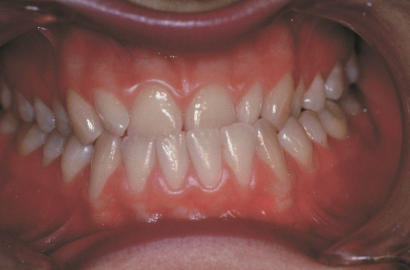 File:Pre Crossbite.jpg