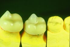 Figure 7a: View of the Empress framework in the laboratory phase where only the active centric cusps of the molars were layered.