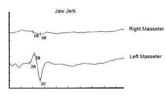 Figure 1b: The second test is the jaw jerk which returns a sort of analysis of the integrity of the midbrain system. In our case 'Balancer' an abnormal asymmetry is evident to the detriment of the right masseter