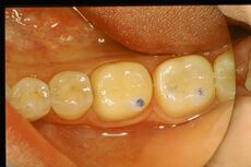 Figure 7b: View of the Empress structure in the clinical phase in the mouth on which to perform trigeminal electrophysiological tests.