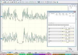 PSM - Masseter mechanical Silent Period.jpg