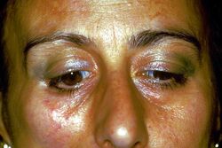 Figure 1a: Paziente diagnosticata precedentemente seguendo il modello RDC come affetta da Disordini Temporomandibolari.