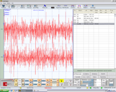 Figura 3: δ3 Interferential EMG of right (top) and left (bottom) masseter muscles. Amplitude 200μV per division, time division 100 msec
