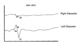 Figure 7: γ1= Jaw Jaw jerk in maximum intercuspidation