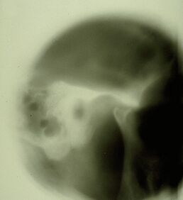 Figura 2: Stratigrafia dell'ATM del paziente evidenziante appiattimento condilare e presenza di osteofiti.