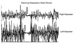 Figura 1f: Codice linguaggio macchina decriptato in 'Latenza Periodo Silente Elettrico '. Diagnosi definitiva ' Meningioma '