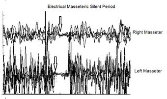 Figure 1c: After verifying the level of integrity of the midbrain area through tests involving monosynaptic reflexes such as jaw jerk, the level of complexity is raised by evoking the electrical silent period which is a polysynaptic reflex. The latency delay on the right masseter is evident