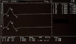 Figure 5: γ1= Potenziali Evocati Motori delle radici del trigemino