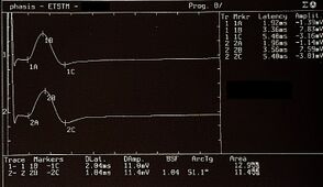 γ1= Trigeminale Root-MEPs: To the motor evoked response of the trigeminal roots recorded on the masseter muscles called bRoot-MEPs.[2][3] This neurophysiological response indicates the anatomical component of the trigeminal motor system of the individual being examined and contextually the absolute amplitude value which, obviously, would correspond to the neuronal energy evoked by the depolarization of all the trigeminal motor fibres contained in the motor root. This very important datum determines the absolute value to which other reflections such as jaw jerk and lateral symmetry refer. Already from these first two questions, we can conclude that the average amplitude ≊30%of the Root-MEPs we are faced with a datum far beyond the limit, namely ≊79%which represents a sort of hyper-excitability of the midbrain response.