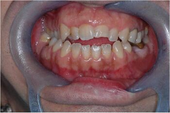Figura 1a: Paziente con malocclusione, morso aperto e morso incrociato posteriore destro che in termini riabilitativi deve essere trattato con terapia ortodontica e/o chirurgia ortognatica