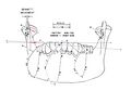 Figure 4: Representation of the real mandibular kinematics composed of simultaneous rotation and translation. Effect of losing an angular degree of freedom on the X axis