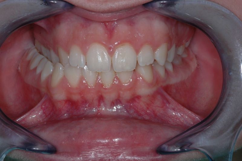 File:1184px-Occlusion in young lady, needing attention.jpg