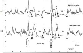 γ4= Recovery Cycle of MIR: The recovery cycle of the crRIM masseteric inhibitory reflex must be conceptually coupled to the exaggerated amplitude of the jaw jerk because it indicates a condition of hyperexcitability which certainly involves the mesencephalic nuclei with increased excitability of the γ motoneurons and of the polysynaptic circuitry responsible for inhibition of the motor neuron of the masseter silent period. Take into account the value of the cognitive process of the neural network which has identified the decryption key of neural hyperexcitability in the crRIM. Only with the jaw jerk exam, we would never reached the decryption until the patient's symptoms had worsened enough to require an MR but we all know that this eventuality could be delayed and fatal. Logically, the diagnosis following this process could have been made even 10 years earlier because a sort of attenuated hyperexcitability would certainly have already been present such as to make the physician suspicious.