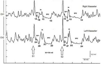 Figure 3: Bruxist patient classified in the RDC protocol in group I,2 Rifascial pain with limitation of mouth opening. Definitive diagnosis 'Cavernosa Pineal'