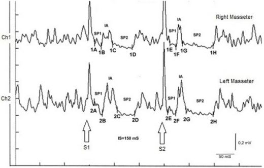 Figure: Masseter Inhibitory Reflex (rcMIR) recovery