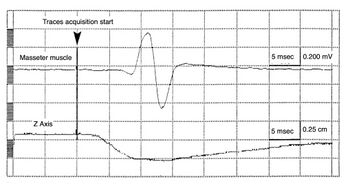Figure 2b: The same trace as figure 2a after modifying the Sirognathograph hardware. Increasing the sampling frequency allowed the real spatial position of the mandible to be detected.