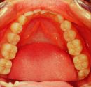 Figura 9b: Vista occlusale della riabilitazione Neuro evocata Funzionale e ripristino normocclusale incisale con due corone in Empress ( lavoro eseguito nel 1992)