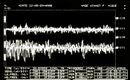 Figure 5: δ2= Pattern interferenziale EMG. Tracce superiori sovrapposte corrispondenti al massetere destro, in basso al massetere sinistro.