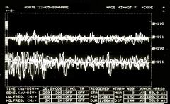 Figura 2a: Functionally asymmetric interference EMG pattern