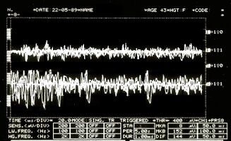 Figure 5: δ2= EMG Interferential Pattern. Overlapping upper traces corresponding to the right masseter, lower to the left masseter.