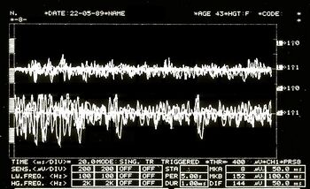 Figura 5: Schema interferente EMG. Tracce superiori sovrapposte corrispondenti al massetere destro, in basso al massetere sinistro.