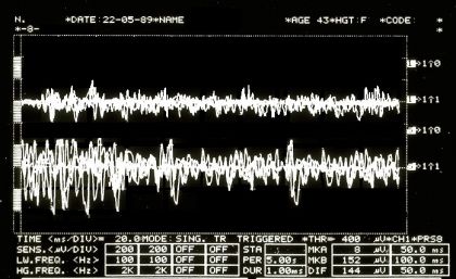 Representative clinical signal: Interferential EMG pattern showing asymmetric muscular activity. Probabilistic interpretation becomes necessary when deterministic causal attribution is not possible.