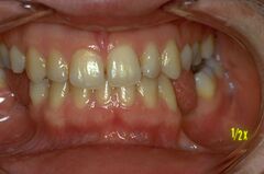 Figure 1a: Patient discharged from the orthognathic surgery department