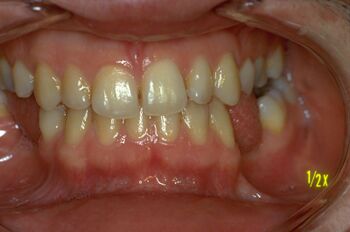 Figura 1: Patient n ° 2 after orthognathic surgery therapy for a III skeletal class. The restoration of 'Normal occlusion' is formally optimal, at least, with respect to the occlusal image of patient n°1. Apart from a slight deviation of the incisal central line and the partial mandibular edentulism, the patient reports a remarkable aesthetic satisfaction and good apparent masticatory function with great satisfaction of the maxillofacial surgeons.