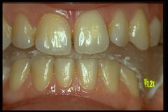 Figure 1c: Mandibular position alignment after 'Neuro Evoked Centric position'