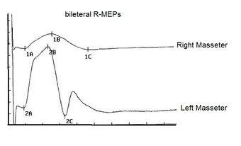 Figure 1a: The first test that must always be performed in complex clinical cases is, in fact, the bRoot-MEPs