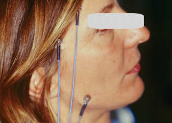 Figura 5: Paziente riabilitata seguendo le indicazioni posturologiche da dati dinamometria.