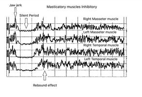 Figura 8b: Periodo silente meccanico registrato sui muscoli masseteri e temporali dopo trattamento Neuro Gantolgico Funzionale