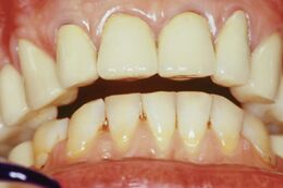 Figure 7: Centric position resulting from bRoot-MEPs. Note the retrusion of at least 3mm and the leftward displacement of the mandible.