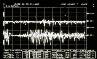 Figure 4: Mechanical silent period detected electrophysiologically on the right (upper overlapping traces) and left (lower overlapping traces) masseters