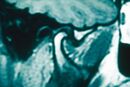 Figura 2: δ1=0⟶ immagini RM dell'articolazione temporo-mandibolare (lato destro mostrato solo per semplificazione) non mostrano segni di deragliamento meniscale e/o infiammazione. Rapporto risultato negativo.