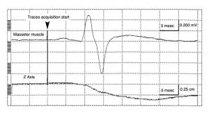 700px-Sirignathograph e jaw jerk 1.jpg