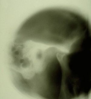 387px-Spasmo emimasticatorio ATM.jpg