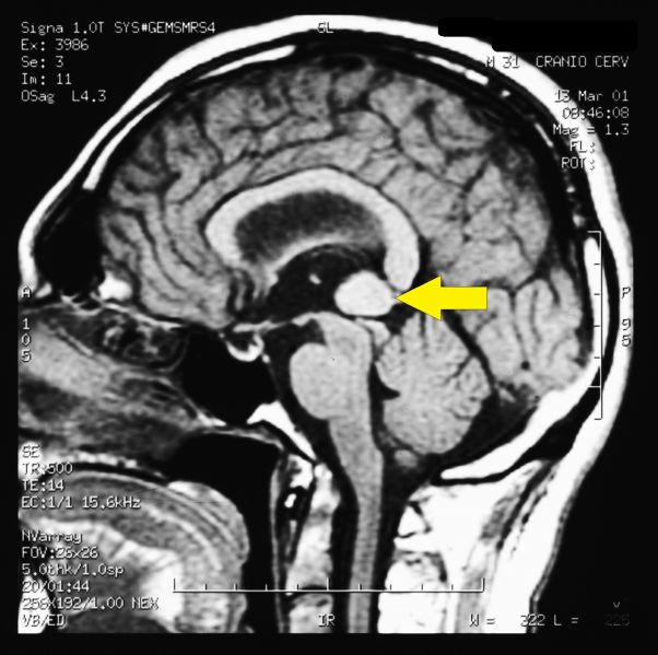 File:Cavernoma Pineale con indicazione.jpg