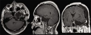 Scwannoma 1.jpeg