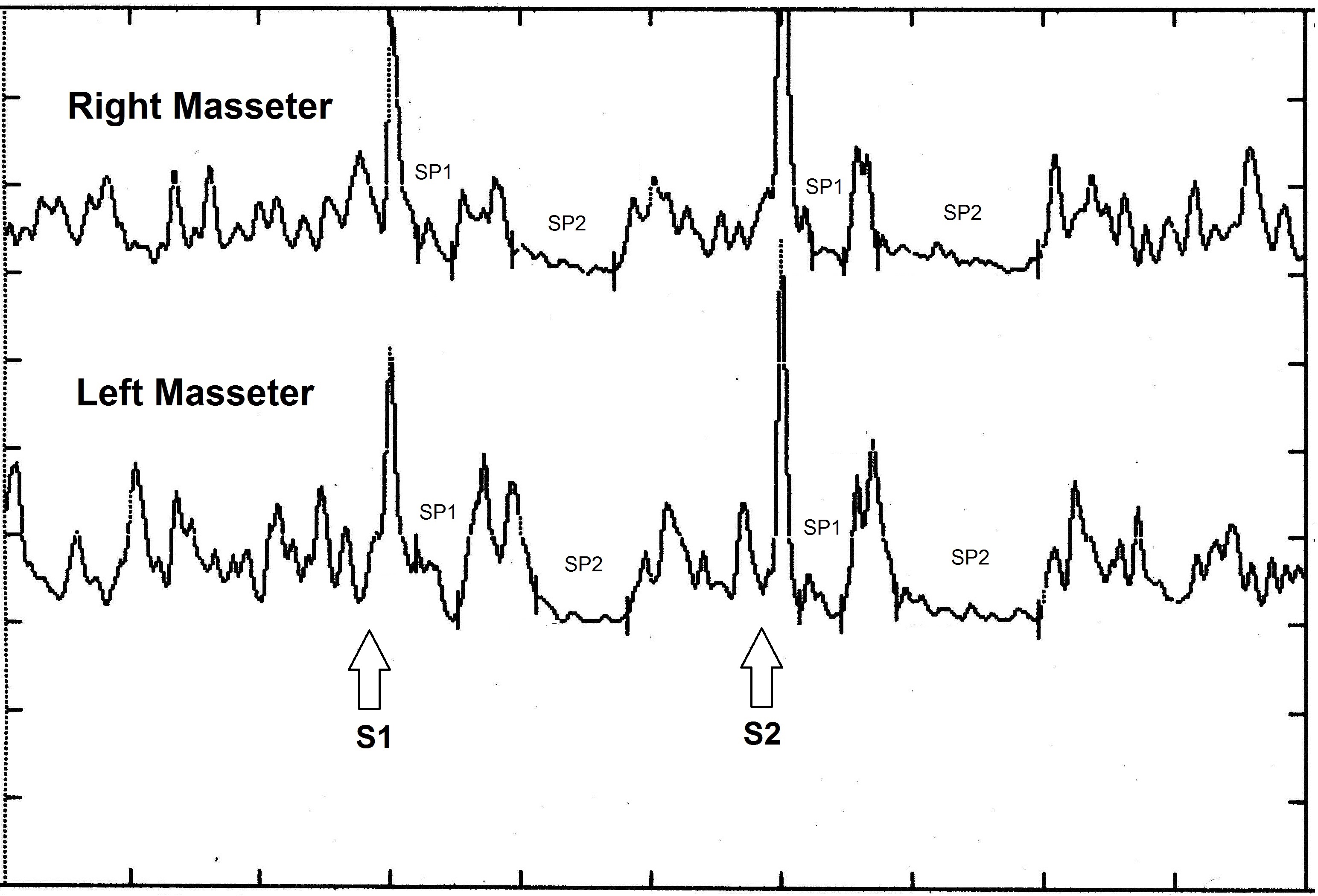 Iper-eccitabilità trigeminale
